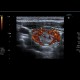 Thyroid nodule: US - Ultrasound