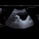 Trabecular hypertrophy of bladder wall: US - Ultrasound