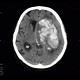 Cerebral hemorrhage, hypertonic hemorrhage, hemocephalus, subfalcine herniation, descendent transtentorial herniation: CT - Computed tomography