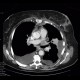 Thrombosis of pulmonary vein: CT - Computed tomography