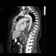 Thrombosis of pulmonary vein: CT - Computed tomography