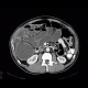 Colorectal cancer, carcinoma of descendens, ileus: CT - Computed tomography