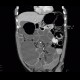 Colorectal cancer, carcinoma of descendens, ileus: CT - Computed tomography