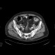 Sigmoid carcinoma, polyp of the ascending colon: CT - Computed tomography