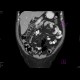 Sigmoid carcinoma, polyp of the ascending colon: CT - Computed tomography