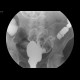 Sigmoid carcinoma, polyp of the ascending colon: RF - Fluoroscopy