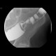 Sigmoid carcinoma, polyp of the ascending colon: RF - Fluoroscopy