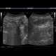 Sigmoid carcinoma, polyp of the ascending colon: US - Ultrasound