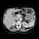 Carcinoma of the lienal flexure: CT - Computed tomography