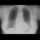 Mediastinal tumour, chest radiograph before: X-ray - Plain radiograph