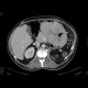 Adrenal tumour, extensive: CT - Computed tomography