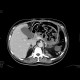 Adrenal tumour, extensive, embolotherapy: CT - Computed tomography
