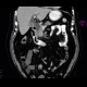 Tumour of pancreatic head: CT - Computed tomography