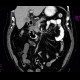 Tumour of pancreatic head: CT - Computed tomography