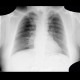Lung tumour, postirradiation changes: X-ray - Plain radiograph