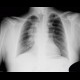 Lung tumour, postirradiation changes: X-ray - Plain radiograph