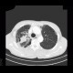 Bullous emphysema, lung tumour: CT - Computed tomography