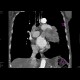 Lung tumour growing into the left atrium through a pulmonary vein: CT - Computed tomography