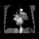 Lung tumour growing into the left atrium through a pulmonary vein: CT - Computed tomography