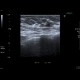 Breast tumour: US - Ultrasound