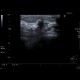 Breast tumour: US - Ultrasound