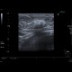 Breast tumour: US - Ultrasound