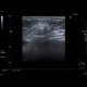 Breast tumour: US - Ultrasound