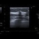 Breast tumour: US - Ultrasound