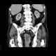 Colorectal cancer, carcinoma of rectum: CT - Computed tomography
