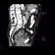 Colorectal cancer, carcinoma of rectum: CT - Computed tomography