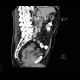 Colorectal cancer, carcinoma of rectum: CT - Computed tomography