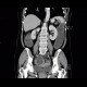 Carcinoma of sigmoid colon, large bowel obstruction, ileus: CT - Computed tomography