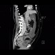 Carcinoma of sigmoid colon, large bowel obstruction, ileus: CT - Computed tomography