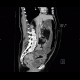 Carcinoma of sigmoid colon, large bowel obstruction, ileus: CT - Computed tomography