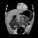 Carcinoma of stomach, scirrhotic carcinoma, infiltration of the wall: CT - Computed tomography