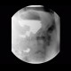 Carcinoma of stomach, scirrhotic carcinoma, infiltration of the wall: RF - Fluoroscopy