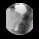 Carcinoma of stomach, scirrhotic carcinoma, infiltration of the wall: RF - Fluoroscopy
