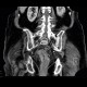 Colorectal cancer, tumorous stenosis of sigmoid colon, placement of stent: CT - Computed tomography