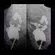 Colorectal cancer, tumorous stenosis of sigmoid colon, placement of stent: RF - Fluoroscopy