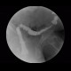 Colorectal cancer, tumorous stenosis of sigmoid colon, placement of stent: RF - Fluoroscopy