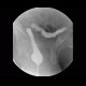 Colorectal cancer, tumorous stenosis of sigmoid colon, placement of stent: RF - Fluoroscopy