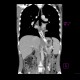 Tumorous stenosis of oesophagus, stent: CT - Computed tomography