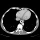 Tumorous stenosis of oesophagus, stent: CT - Computed tomography