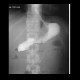 Tumorous stenosis of oesophagus, stent: RF - Fluoroscopy
