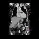 Tumour of chest wall, osteolysis of rib: CT - Computed tomography