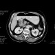 Tumour of duodenum: CT - Computed tomography