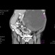 Tumour of pancreas, huge: CT - Computed tomography