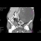 Tumour of pancreas, huge: CT - Computed tomography