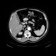 Tumour of transverse colon: CT - Computed tomography