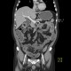 Ulcerative colitis, enterography: CT - Computed tomography